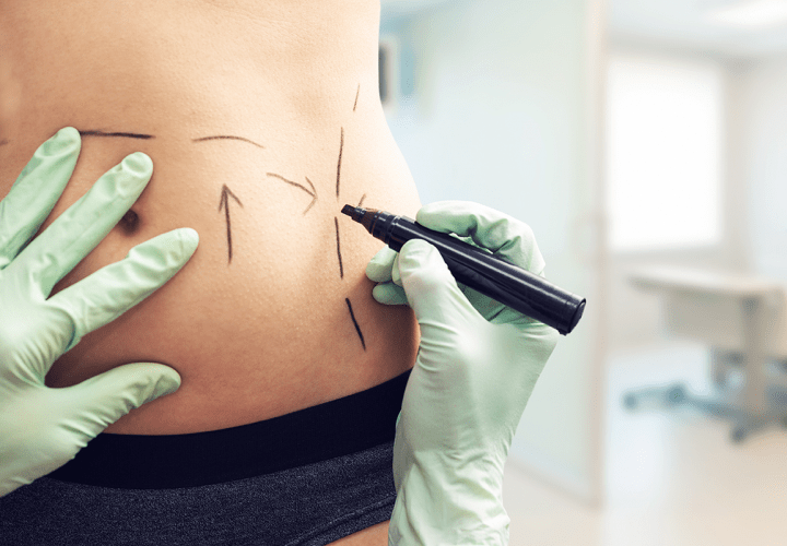 Is Coolsculpting a Painful Procedure? Side Effects and Recommendations for Aftercare