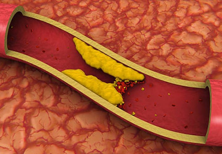 Blood cholesterol and obesity