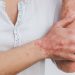 Natural Home Remedies to Prevent Psoriasis Flare-Ups