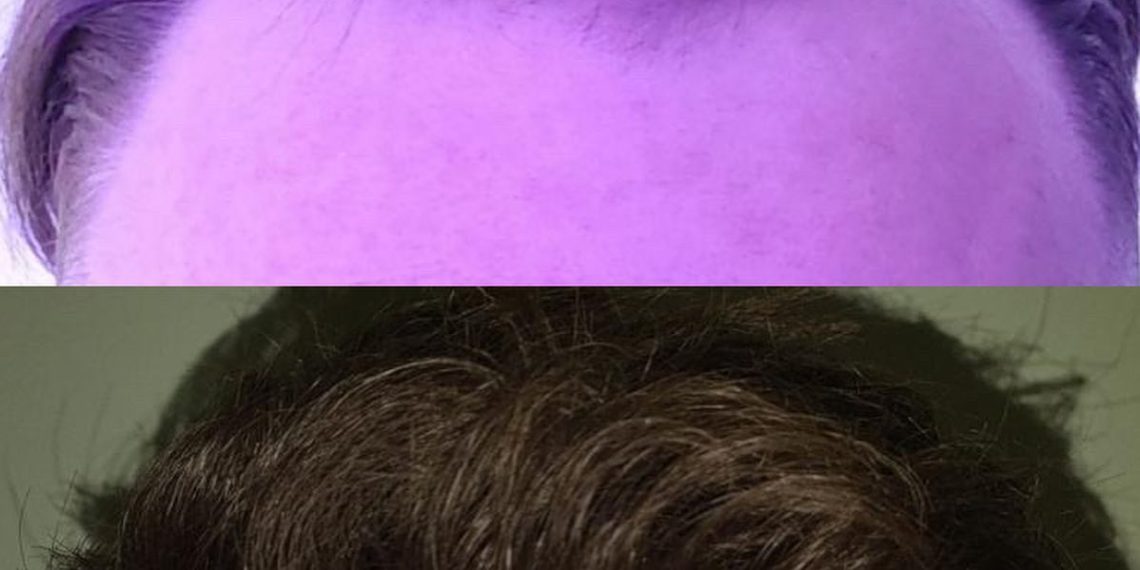 How to Find the Right Hair Surgeon in London: A Comprehensive Guide