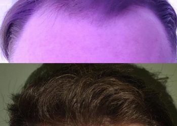 How to Find the Right Hair Surgeon in London: A Comprehensive Guide