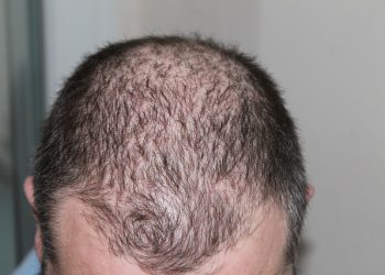Hair Loss