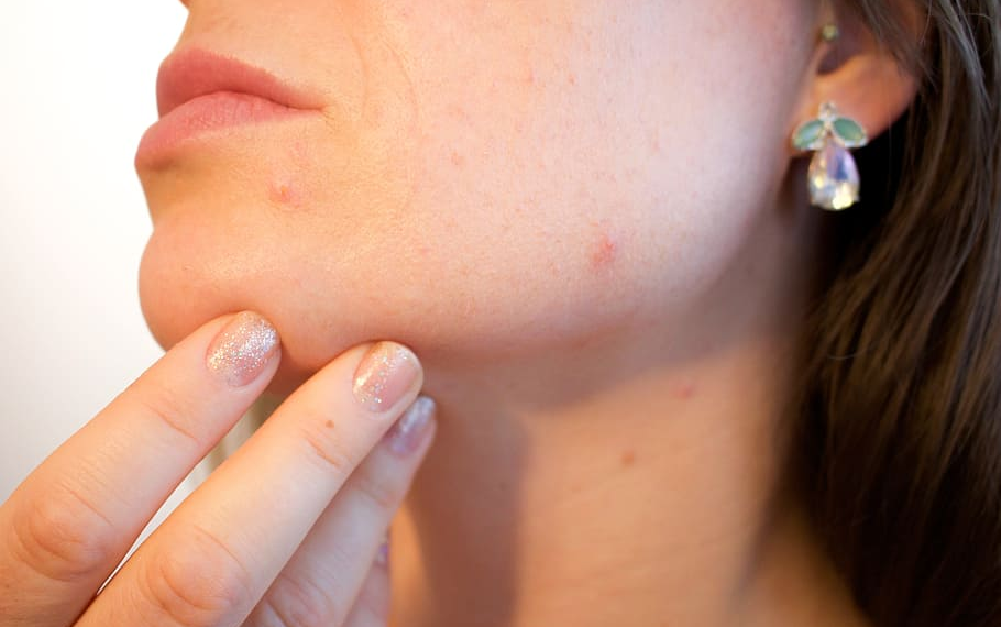 Acne Scar Treatment