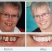 Implant Dentures
