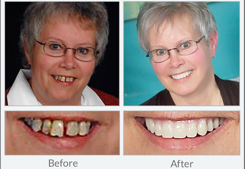 Implant Dentures