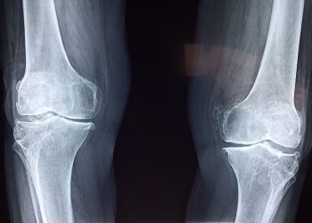 Osteoporosis Detection