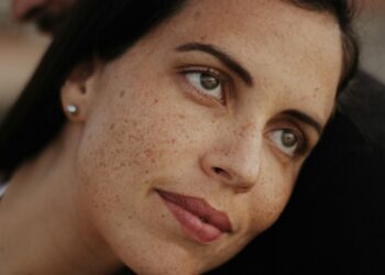 Chemical Peel for Pigmentation