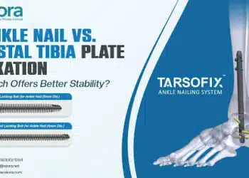 Ankle Nail vs. Distal Tibia Plate Fixation – Which Offers Better Stability?