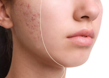 Acne Treatment and Clear Skin