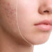 Acne Treatment and Clear Skin